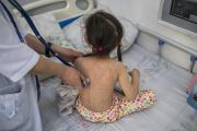 Cuatro municipios de La Paz reportan 10 casos de sarampión hasta este jueves
