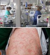 Tres niños están en UTI y seis óbitos en análisis