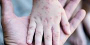 Detectan brote del virus en Oruro: hay dos contagiados y 25 bajo observación