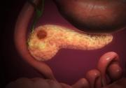 Cáncer de páncreas: estas son las personas con mayor riesgo de padecerlo