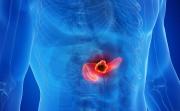 Cáncer de páncreas: por qué es uno de los más difíciles de detectar y a qué señales estar alerta