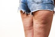 Cómo reafirmar la piel y reducir la celulitis: claves para la salud y el bienestar todo el año