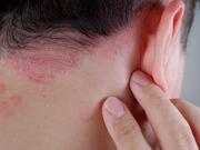 Combatí la psoriasis: conocé los tratamientos que controlan los brotes y cuidan tu piel