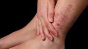 Campaña nacional de detección gratuita de enfermedad psoriásica
