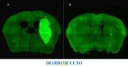 Científicos del CONICET lograron frenar un tipo de cáncer cerebral con una novedosa estrategia terapéutica