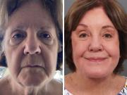 Una mujer de 78 años mostró imágenes de su rejuvenecimiento facial y captó la atención de miles de personas