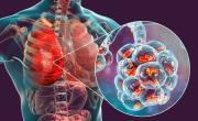 Klebsiella pneumoniae y Ralstonia pickettii, las bacterias del fentanilo contaminado: qué provocan