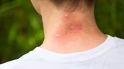 Ni ropa larga, ni repelentes: cómo evitar las picaduras de mosquitos en tu piel