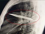 Tenía dolores en un pezón y descubren un cuchillo dentro de su pecho desde hace 8 años