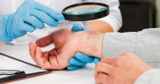 Psoriasis, la enfermedad que si no se trata a tiempo puede ir más allá de la piel, desde la mirada de una profesional sanjuanina