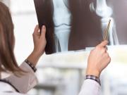 Osteogénesis imperfecta: qué causa huesos frágiles en los niños