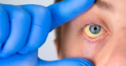 Alerta sanitaria por la enfermedad zoonótica: qué es, cuáles son los síntomas y cómo se contagia