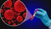 Mieloma múltiple, un cáncer sigiloso 