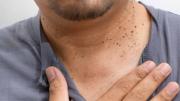 Verrugas en el cuello: causas, tratamientos y cuándo consultar a un dermatólogo