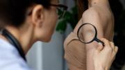 Esta es la manera más segura de eliminar lunares y verrugas en tu piel: alerta con estas sustancias no recomendadas por la FDA