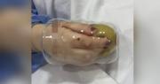 Mujer queda con la mano atrapada en un vaso cuando lavaba y debe ser operada
