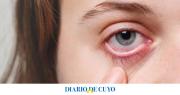El grave error que casi deja ciega a una joven: se duchó con lentes de contacto