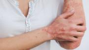 Psoriasis, cuestión de piel y de vida social