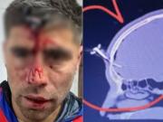 Le clavaron una llave en la cabeza a un jugador del Ascenso durante una salvaje pelea en un torneo de fútbol femenino