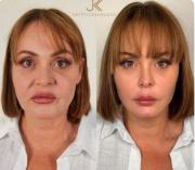 El nuevo rostro de Gaby Spanic tras un tratamiento estético
