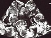 Sorpresa médica: una mujer descubrió que está embarazada de 9 bebés