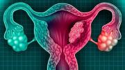Cáncer de cuello uterino: principales recomendaciones para prevenir la enfermedad