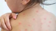 Alerta por brote de sarampión: cómo es el esquema de vacunación y cuáles son los riesgos de la enfermedad