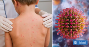 Qué es y cuáles son los síntomas del sarampión: Gobierno emitió una alerta epidemiológica