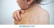 Un caso de sarampión en Entre Ríos reactivó la alerta sanitaria nacional: los detalles del paciente y cómo se encuentra
