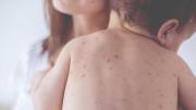 Alerta sanitaria por Sarampión: cuáles son sus síntomas y cómo prevenirlo