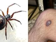 Un joven sobrevivió a la mordedura de una falsa viuda negra, una peligrosa araña venenosa