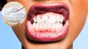 Cómo prevenir el sarro de los dientes usando un poco de bicarbonato de sodio: elemento casero efectivo