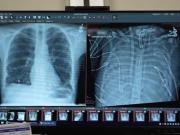 El hombre que vivió 48 horas sin pulmones