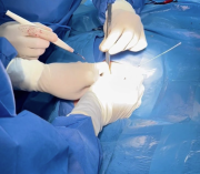 Hospital Universitario de Los Andes inició implantación de marcapasos