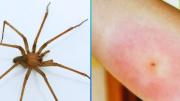 Araña violinista: cuáles son los síntomas de una picadura y qué hacer ante una de ellas