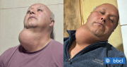 Casi 17 años esperando una operación: el calvario de carpintero que vive con enorme bulto en su cuello