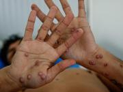 Registran en Argentina el primer caso de la cepa más agresiva y contagiosa de la viruela del mono