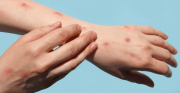 Confirman el primer caso de una variante más contagiosa y severa de la viruela símica en Argentina