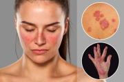El hospital Japonés realizará evaluación gratuita de lupus