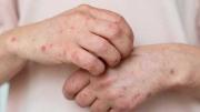 Ministerio de Salud recomienda reconocer síntomas y signos para prevenir el sarampión