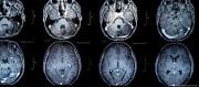 TUMORES CEREBRALES: NUEVA VACUNA OFRECE ESPERANZA DE VIDA