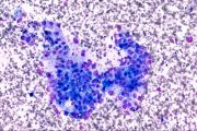 Una vacuna experimental para prevenir el cáncer de páncreas ofrece resultados positivos