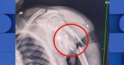 Hombre que fue sacado de una clínica tiene una fractura en el hombro producto de un disparo