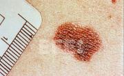 La vacuna experimental del melanoma, entre la expectación y la cautela por falta de datos