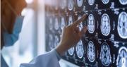 Primer paciente del mundo sometido a una cirugía cerebral asistida por IA en tiempo real