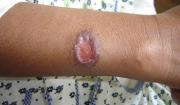 Santa Cruz registra 210 casos de leishmaniasis y refuerza la vigilancia sanitaria