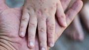 Herpangina y síndrome mano-pie-boca suman cerca de 60 casos en Potosí