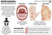 Detectaron 110 casos de herpangina y síndrome de pies – manos y boca en 23 unidades educativas