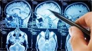 Avance científico contra el Alzheimer: Harvard prueba un tratamiento para recuperar la memoria