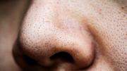 Chau puntos negros: la sencilla mezcla de dos ingredientes que es ideal para limpiar tu rostro